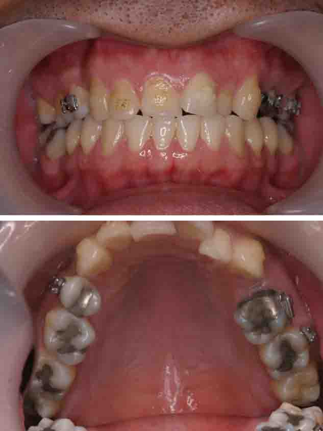 MTMで上顎前歯の歯並びを治療した症例治療前