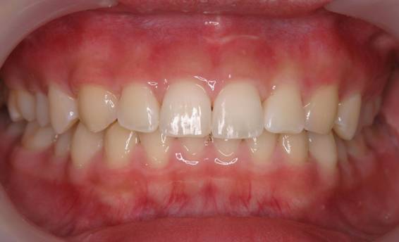 MTM上顎前歯1治療後