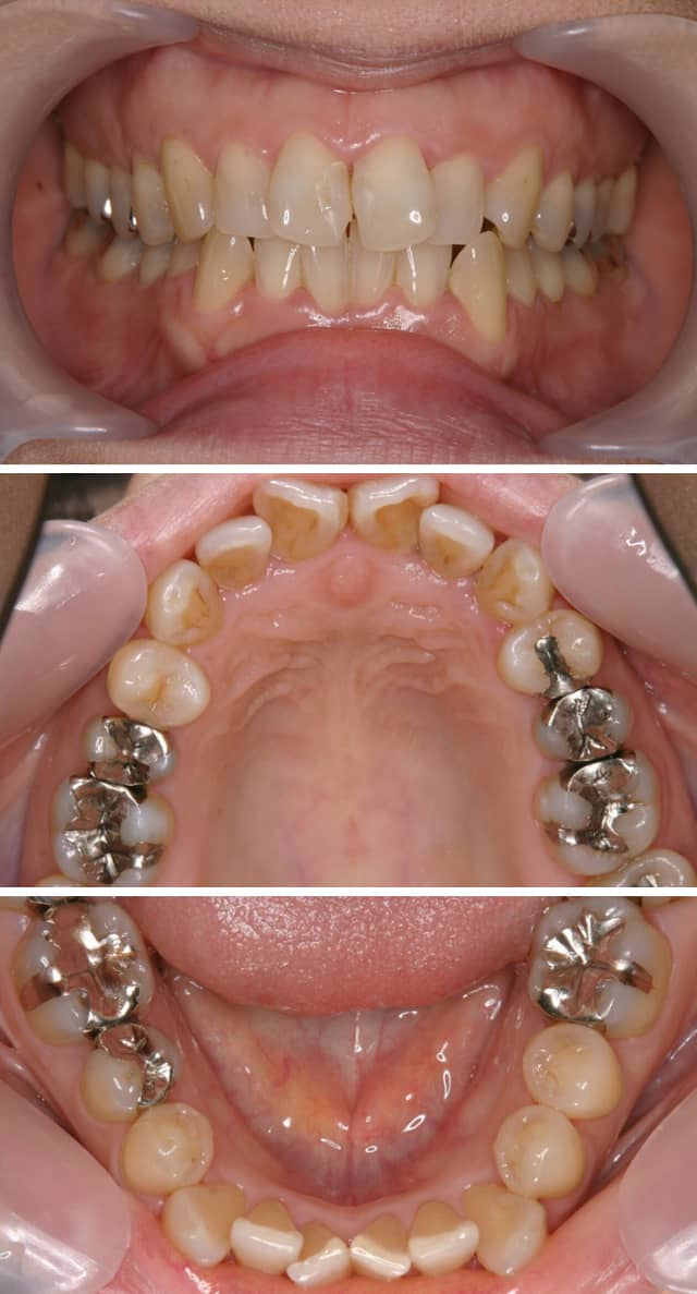 ＭＴＭで上下前歯の歯並びを治療した症例治療前
