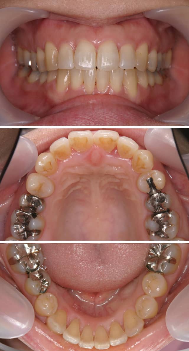 ＭＴＭで上下前歯の歯並びを治療した症例治療後